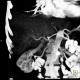 Liver tumour, 3-phase CT: CT - Computed tomography